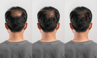 Haarausfall Männer: Ursachen und Therapien